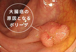 大腸癌の原因となるポリープ