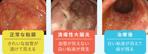 「正常な粘膜」「潰瘍性大腸炎」「治療後」